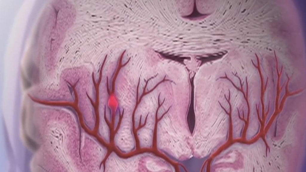 Knowing the signs of a stroke can save lives — Dunwoody Community news